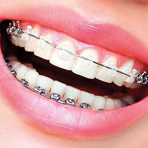 Cu Ntos Tipos De Brackets Existen Cl Nica Dental Nudent Trujillo