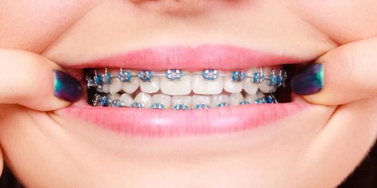 Cu Ntos Tipos De Brackets Existen Cl Nica Dental Nudent Trujillo