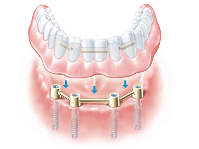 protesis-dental-clinica-nudent-trujillo-ortodoncia-implantes