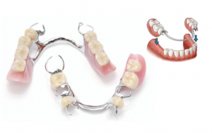 Protesis_dental_trujillo_clinica_nudent