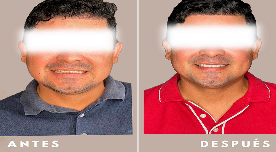 Caso de Implantes Dentales Antes y Después